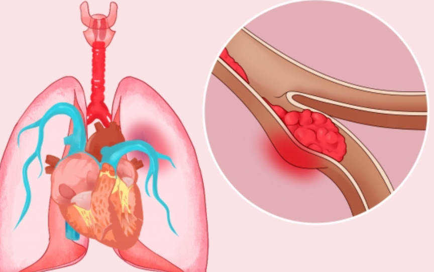 不止心脏会猝死，这些呼吸疾病同样致命！！